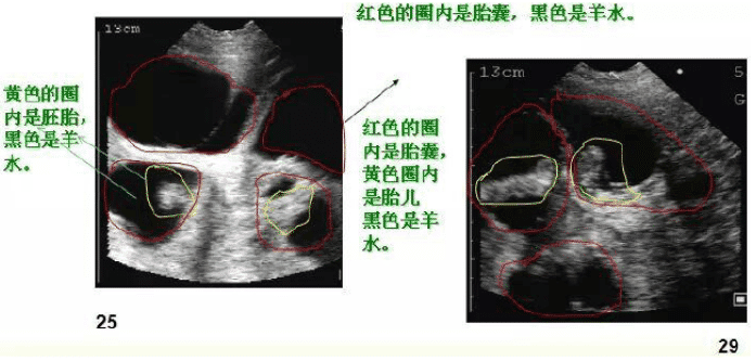 母猪妊娠25到40天B超图像